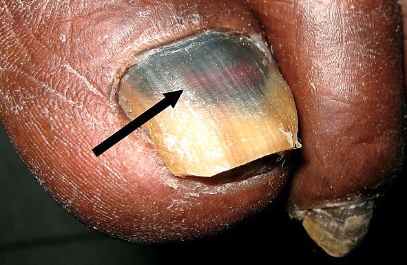 Onychomycose et hématome sous ungéal - la flèche montre l'hématome